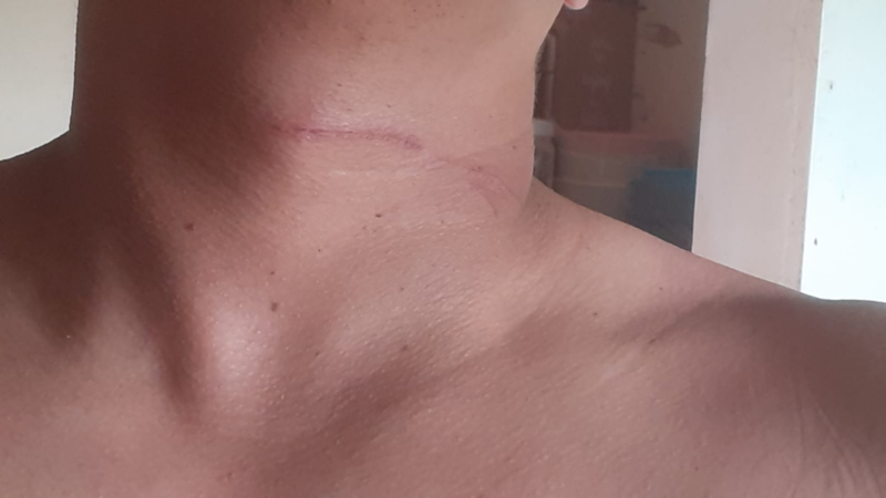 Linha ‘papagaio’ atinge pescoço de motociclista em Santana